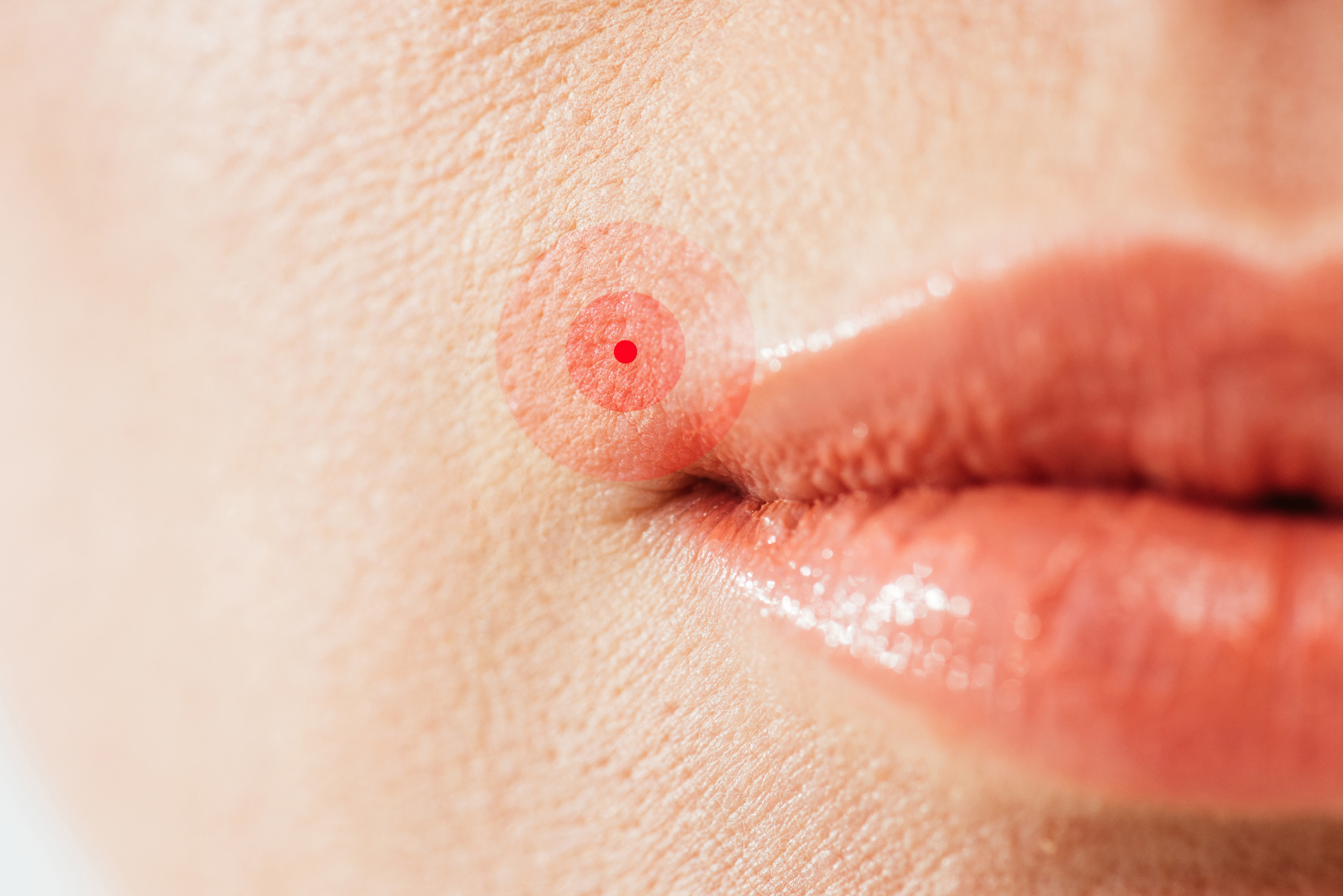 Herpes labial in Köln